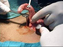  appendectomy open surgery 
